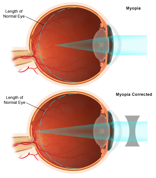 MYOPIA