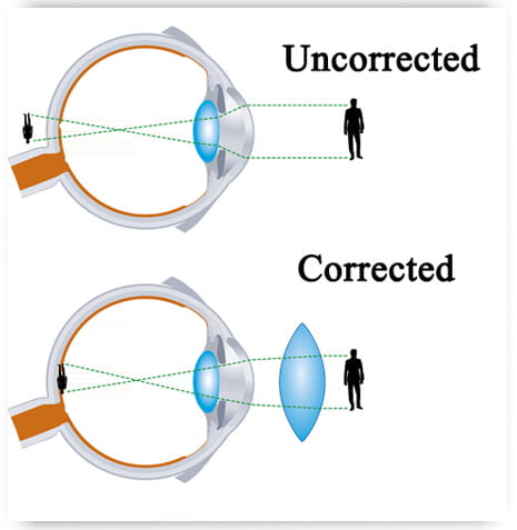 Presbyopia1