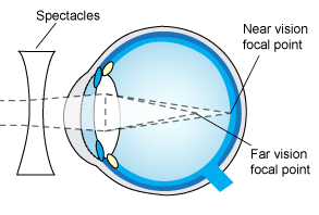 presbyopia 2