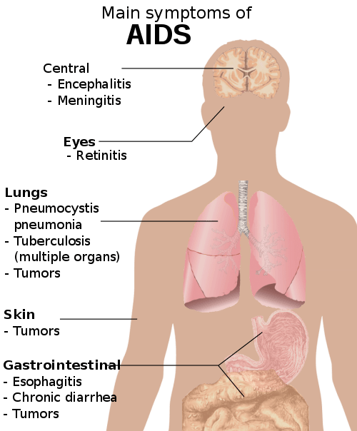 500px Symptoms of AIDS.svg