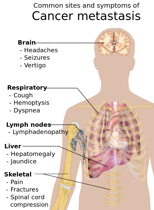 600px Symptoms of cancer metastasis.svg