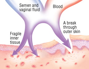 HIV AIDS 1