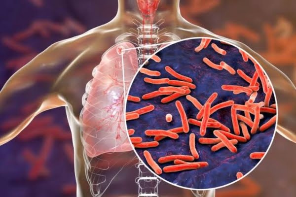 World TB Day