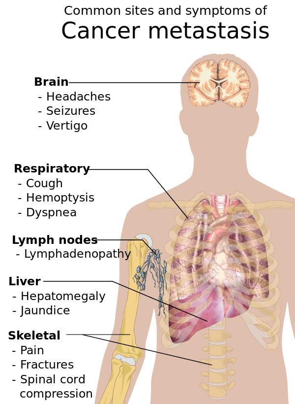 600px Symptoms of cancer metastasis.svg