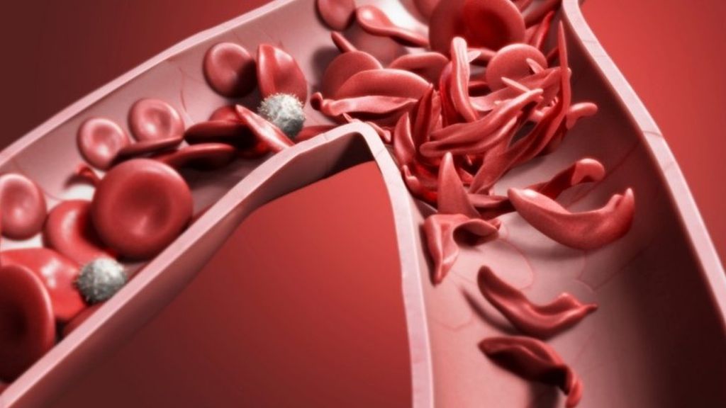 Sickle cell disease Nurses need better training says health union