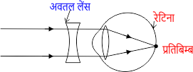 निकट दृष्टि दोष