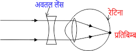 निकट दृष्टि दोष