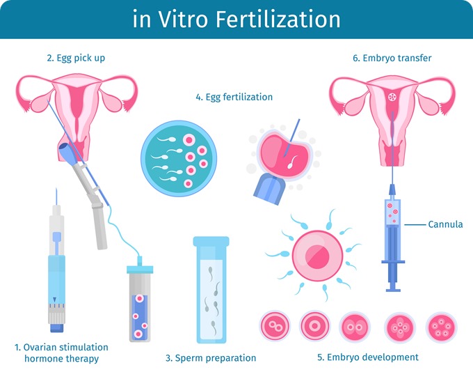 IVF process infographic ectorPot thumb 1